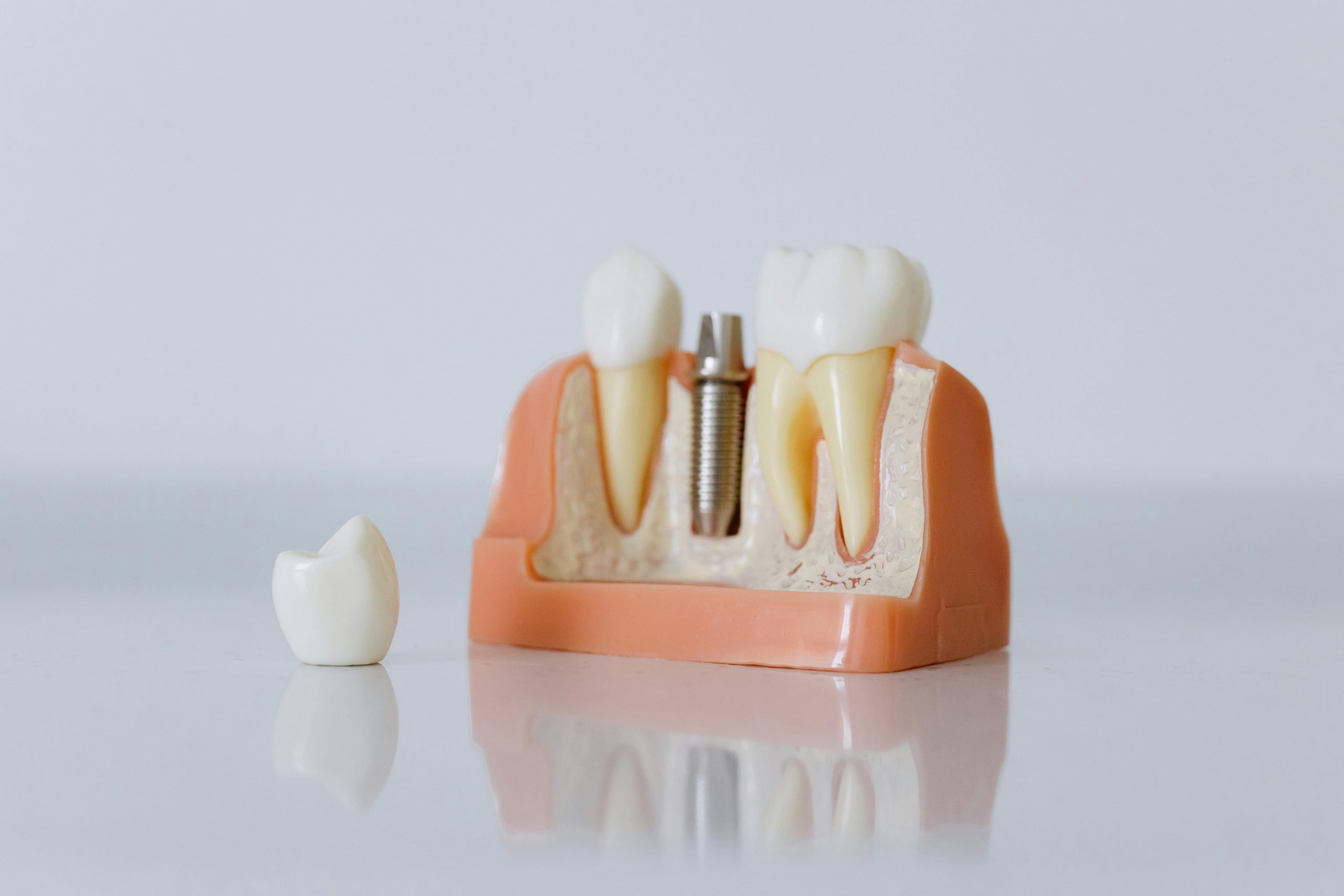 dental model displaying three teeth, including one with a dental implant, and a single tooth next to it