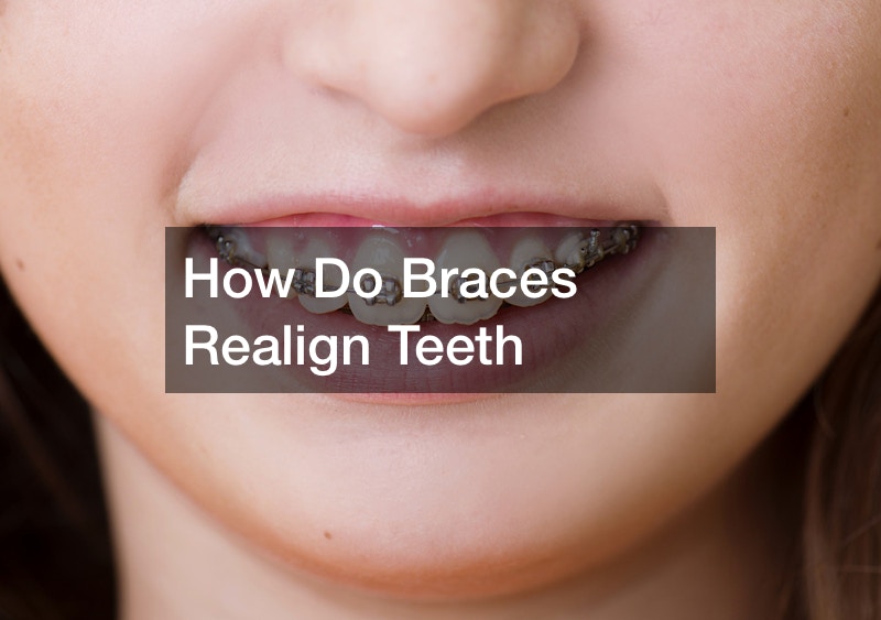 How Do Braces Realign Teeth Uncovering the Dental Implant Process