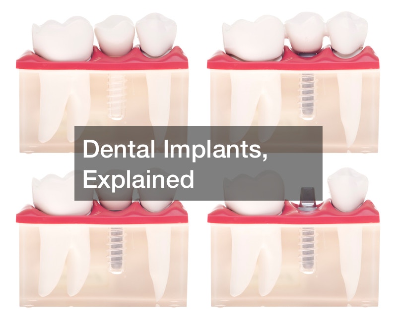 Dental Implants, Explained