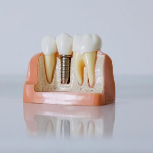 dental model showing three teeth, including one with a dental implant