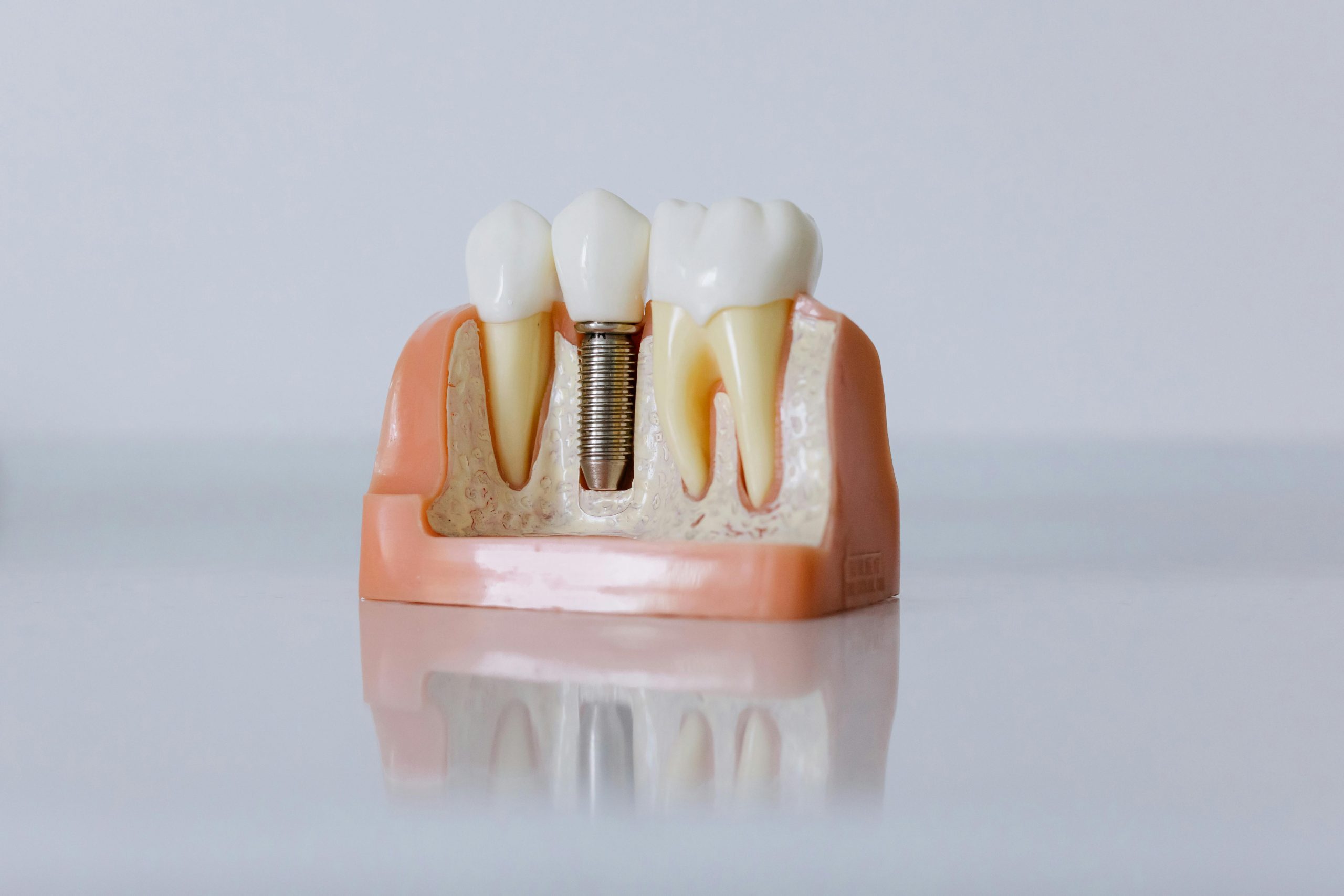 dental model showing three teeth, including one with a dental implant