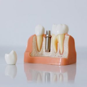 a dental implant