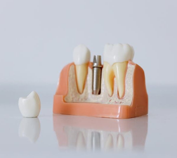 a dental implant