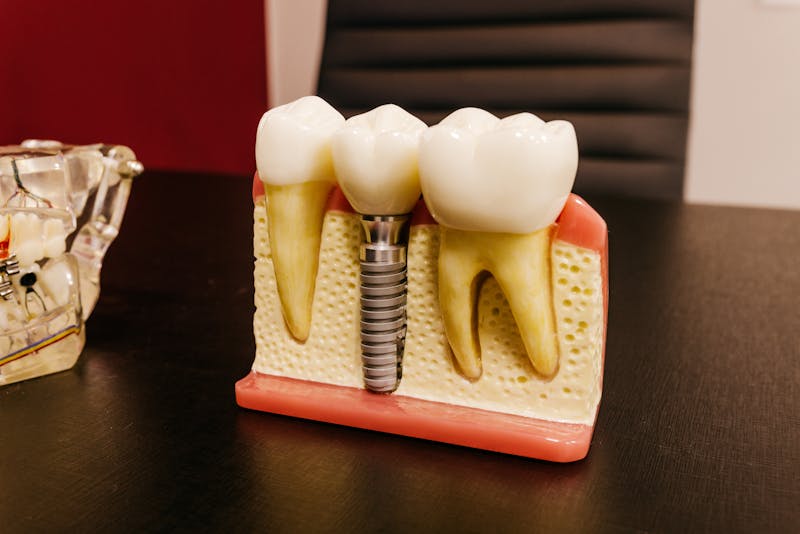 endosteal dental implant