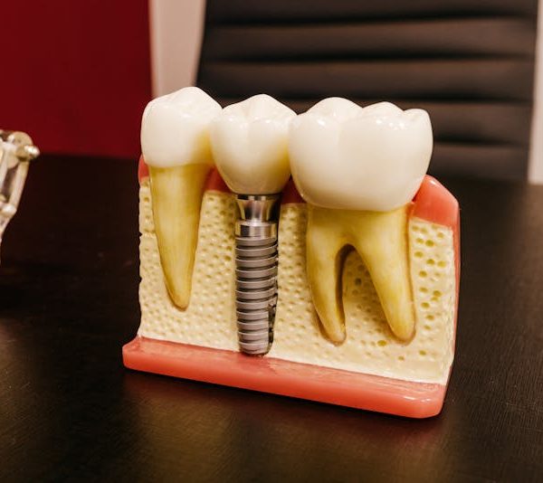 What are Screwless Dental Implants? A Complete Patient Guide