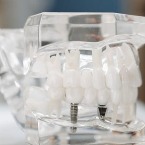 dental implant and other remaining teeth