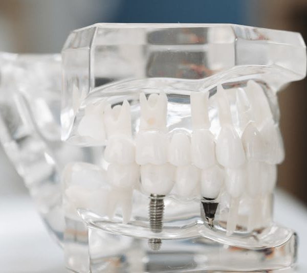 dental implant and other remaining teeth