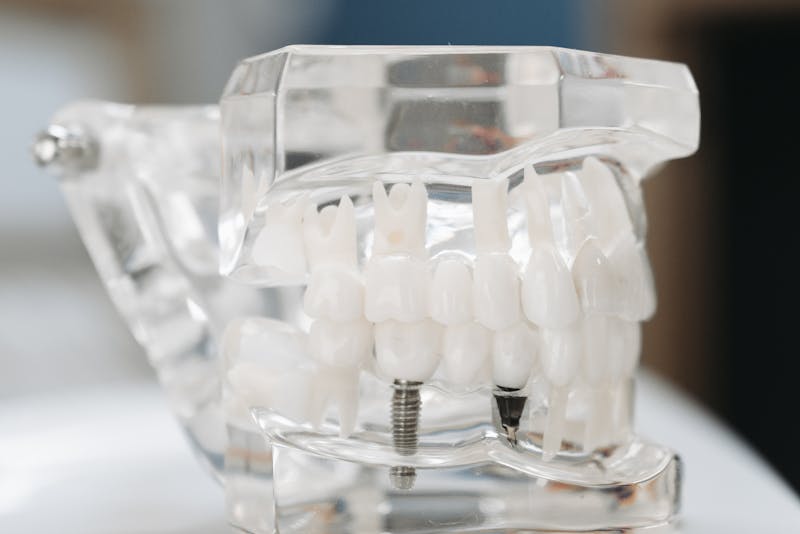 dental implant and other remaining teeth